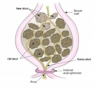 frawing of impacted bowle
